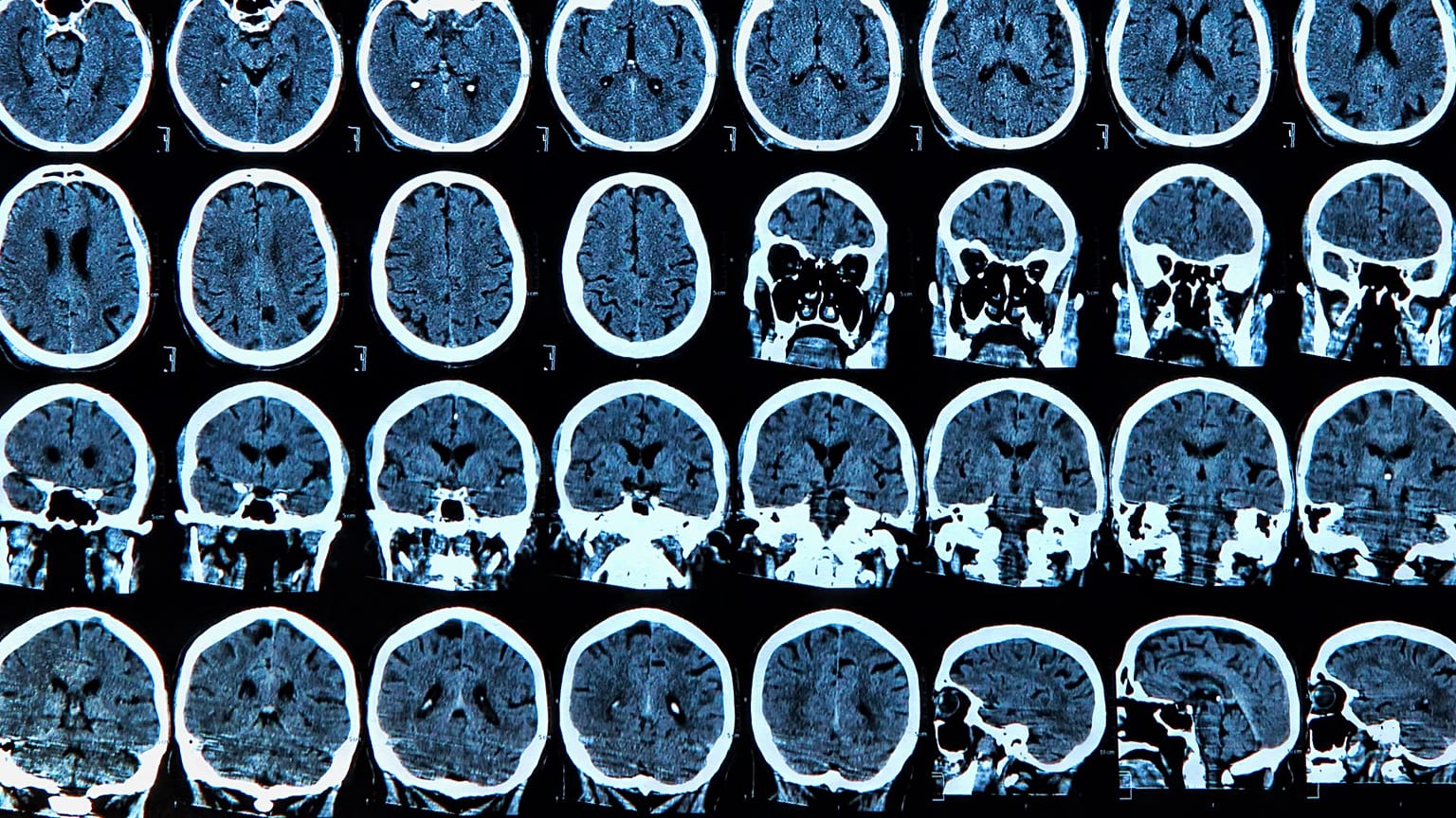 COVID has been found to cause potentially significant changes to the structure of the brain