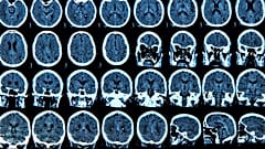COVID has been found to cause potentially significant changes to the structure of the brain