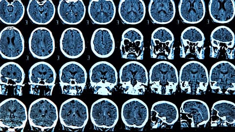 COVID has been found to cause potentially significant changes to the structure of the brain