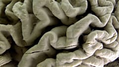 بیماری آلزایمر و سلول‌های مغز انسان