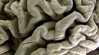 بیماری آلزایمر و سلول‌های مغز انسان