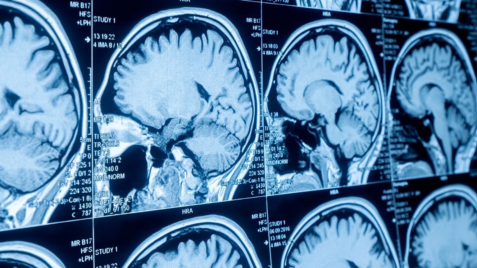 The drug shows promise in slowing down the onset of the disease