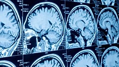 The drug shows promise in slowing down the onset of the disease