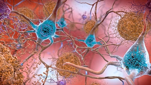 This illustration depicts cells in an Alzheimer’s affected brain, with abnormal levels of the beta-amyloid protein forming plaques, brown, that collect between neurons.
