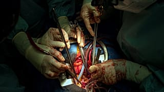 جراحون خلال عملية زراعة قلب في مستشفى جامعة بويرتا بالقرب من مدريد، إسبانيا.