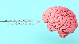 Die Stentrode-Schnittstelle ist ein streichholzgroßes, netzartiges Gerät mit Elektroden, das in das Gehirn implantiert wird.