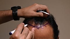 إجراء عملية زرع شعر بإحدى العيادات في الهند
