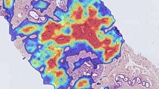 استفاده از هوش مصنوعی در تشخیص سرطان پستان توسط موسسه کوری