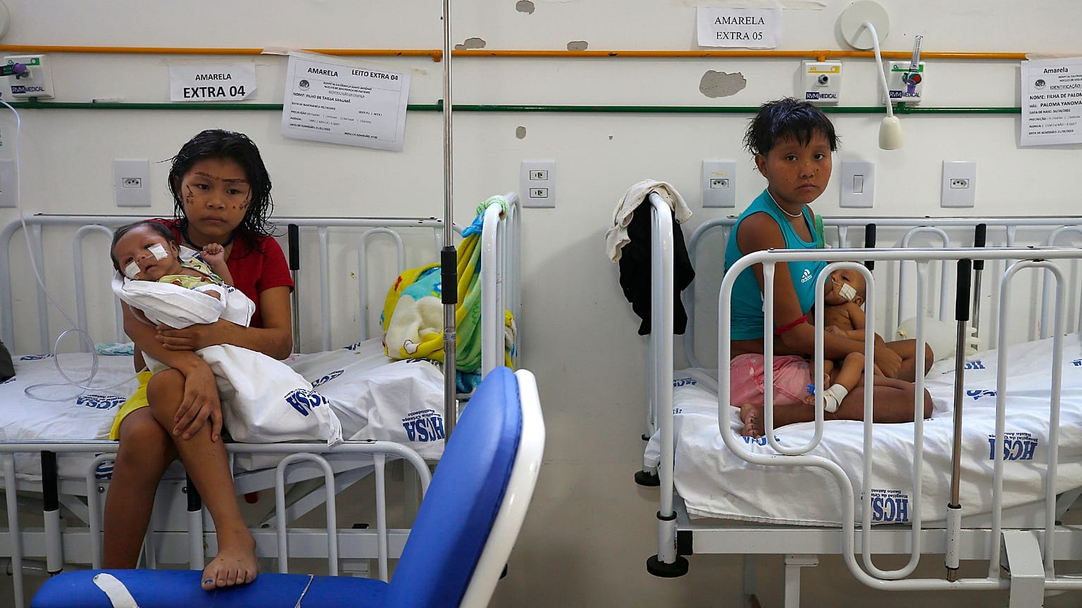 Problemas de malnutrición entre los Yanomami