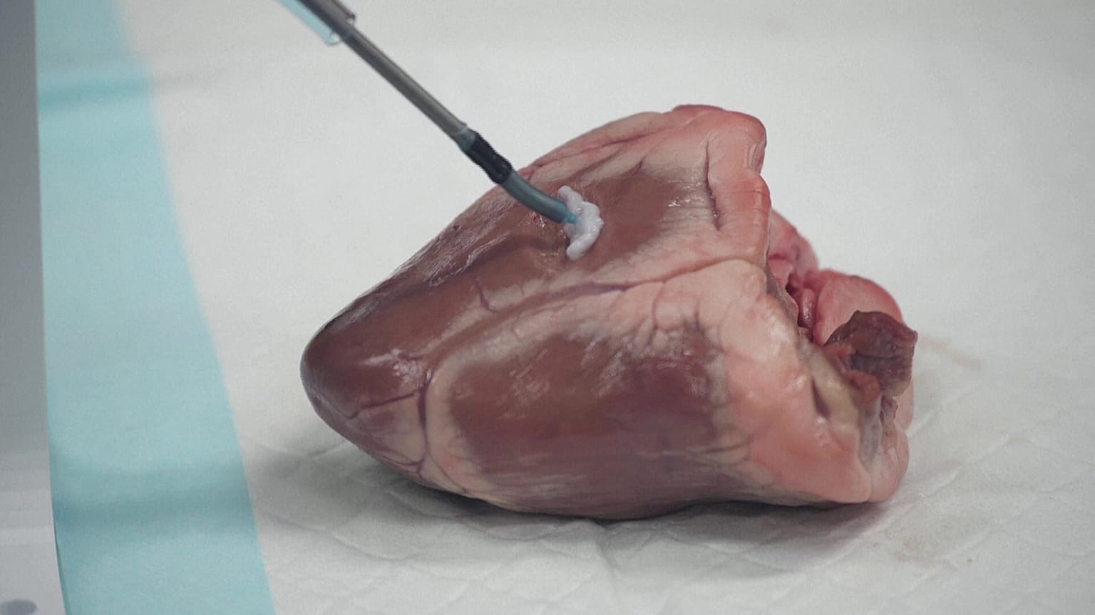 A small flexible robot that can be used to 3D print biomaterials directly inside the human body