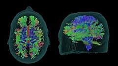 Yeni Alzheimer ilacı 'donameab' hastalığın ilerlemesini üçte bir yavaşlatıyor