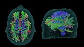 Yeni Alzheimer ilacı 'donameab' hastalığın ilerlemesini üçte bir yavaşlatıyor