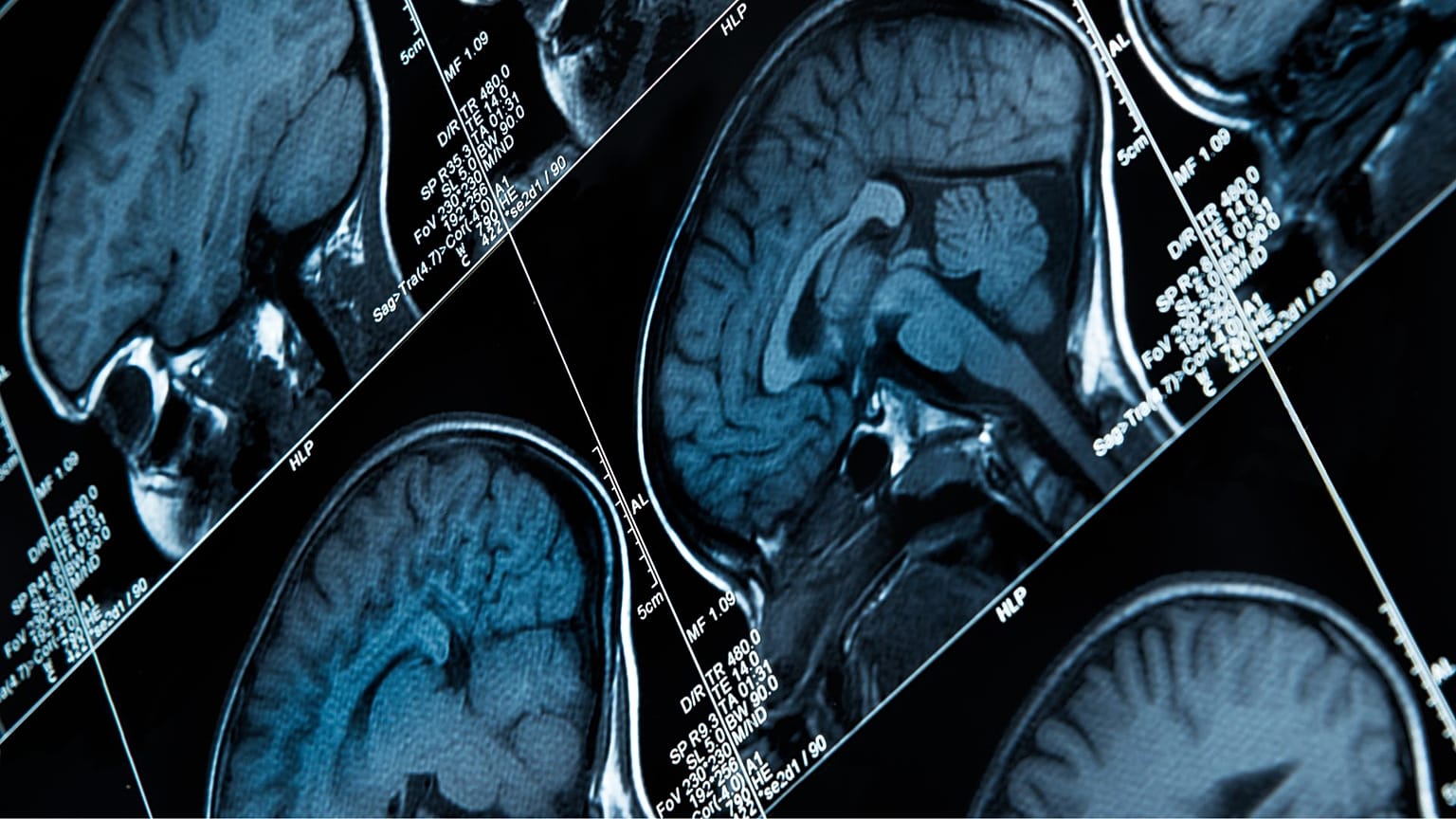 Researchers have decoded brain signals for pain for the first time