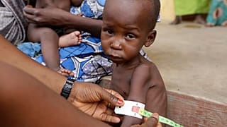 FILE- A doctor attends to a malnourished child at a refugee camp in Yola, Nigeria. Sunday, May 3, 2015.