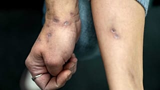 Xylazine-induced lesions cover Amy Treglia's arms and other part of her body. Continued use of the drug causes abscesses that can require amputation.