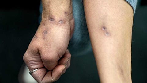 Xylazine-induced lesions cover Amy Treglia's arms and other part of her body. Continued use of the drug causes abscesses that can require amputation.