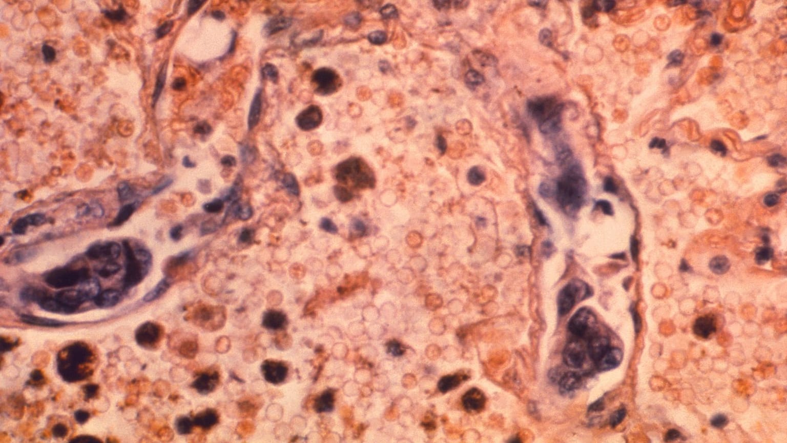 Lung cancer has long been notoriously difficult to treat