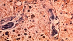 Lung cancer has long been notoriously difficult to treat