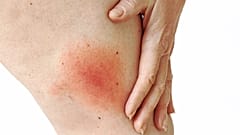 تورم ناشی از گزش حشره کنه