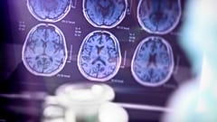 A new Alzheimer's drug has just been granted full approval by the US Food and Drug Administration.