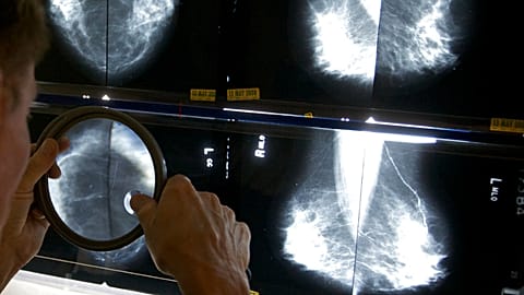 A radiologist uses a magnifying glass to check mammograms for breast cancer in Los Angeles.