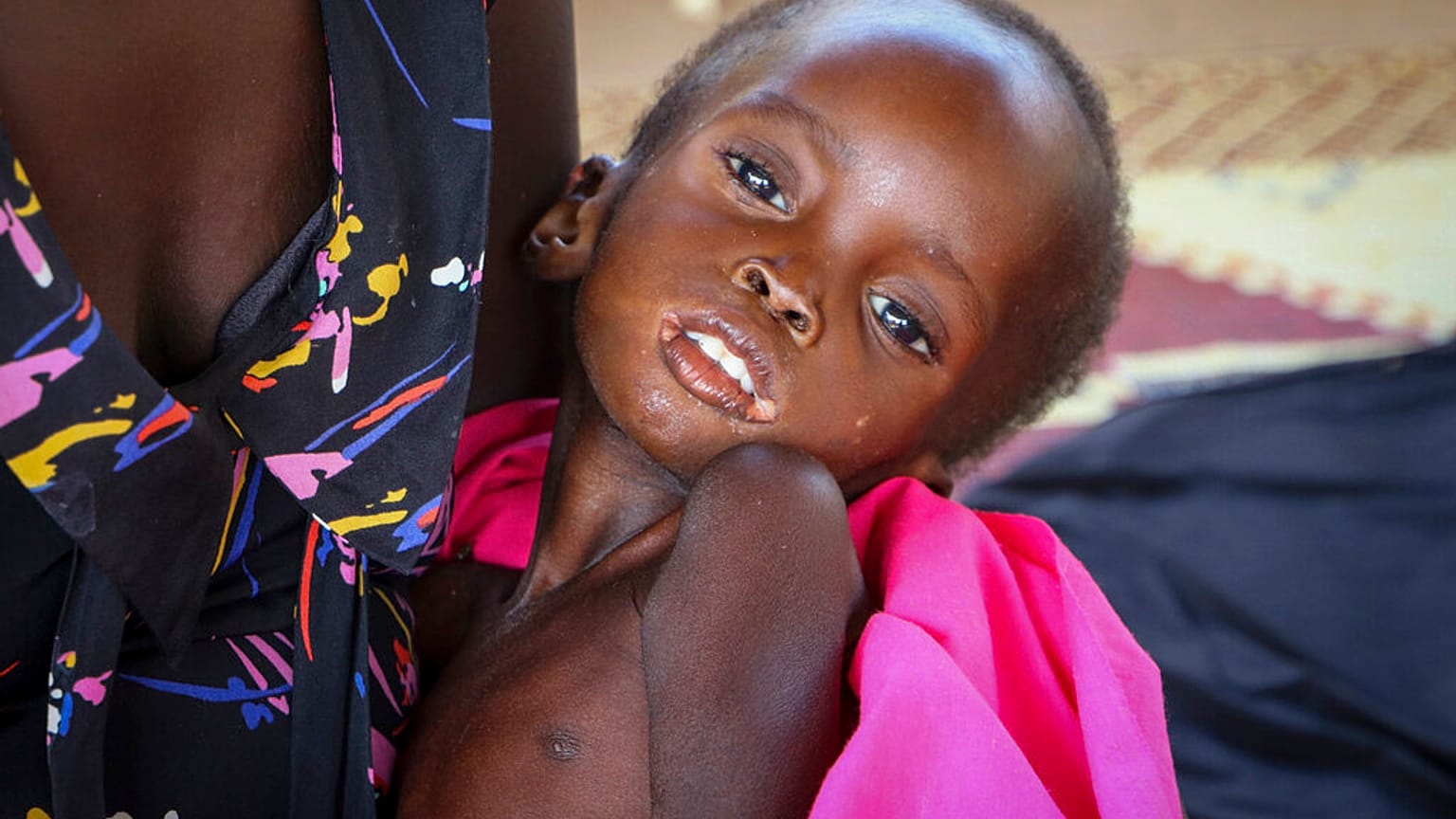Sudan'da yetersiz beslenmeye bağlı hastalıklar nedeniyle çok sayıda çocuk hayatını kaybediyor