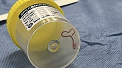 Der Wurm wurde aus dem Gehirn der Patientin geholt. Wir er dort hineinkam, war zunächst unklar. 