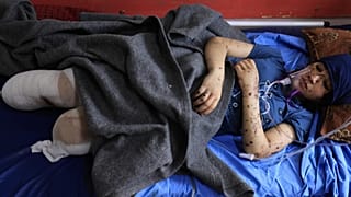 الطفلة الفلسطينية ليان الباز التي بترت ساقاها في قصف إسرائيلي على قطاع غزة تتلقى العلاج في مستشفى ناصر بخان يونس