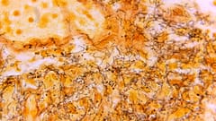 A 1966 microscope photo shows a tissue sample with the presence of numerous, corkscrew-shaped, darkly-stained bacteria responsible for syphilis.