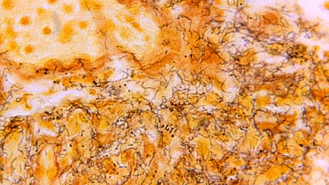 A 1966 microscope photo shows a tissue sample with the presence of numerous, corkscrew-shaped, darkly-stained bacteria responsible for syphilis.