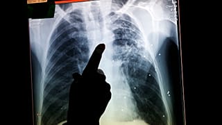 In thisOct. 16, 2013 photo, a radiographer points to a file X-ray, made in the past at a patient in Ireland that was diagnosed with tuberculosis, at a van in London.