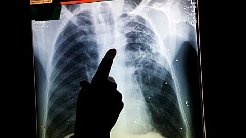 In thisOct. 16, 2013 photo, a radiographer points to a file X-ray, made in the past at a patient in Ireland that was diagnosed with tuberculosis, at a van in London.