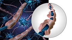 A 3D illustration compares normal nerves to ones affected by MS. 