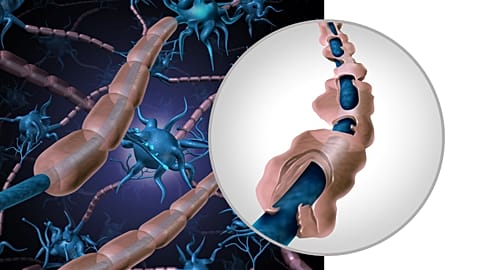 A 3D illustration compares normal nerves to ones affected by MS. 