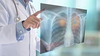 تشخیص زود هنگام سرطان ریه راه مبارزه با آن