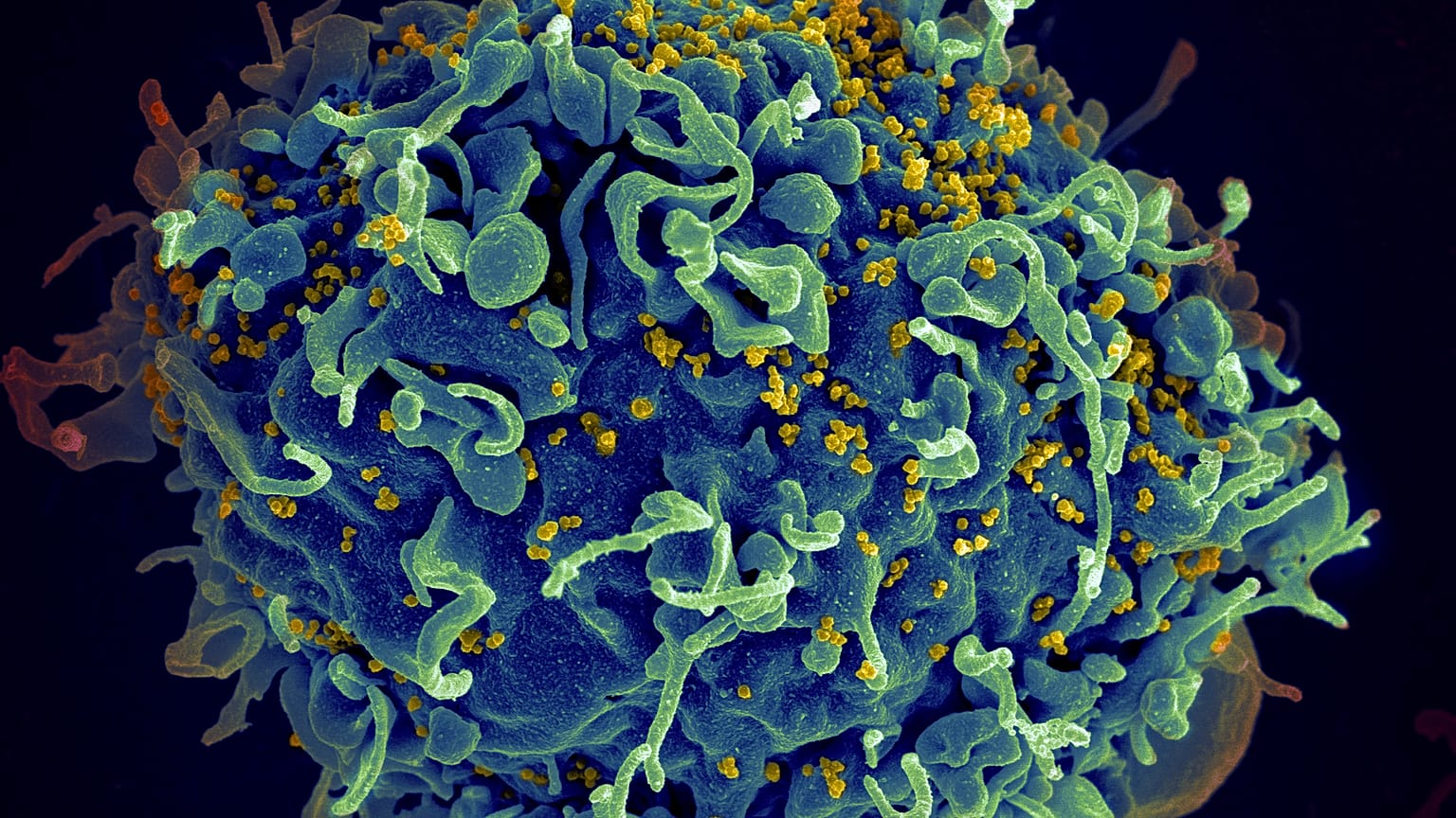 This electron microscope image shows a human T cell, in blue, under attack by HIV, in yellow, the virus that causes AIDS.