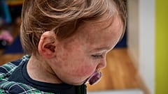 Baby mit Hautausschlag im Gesicht.