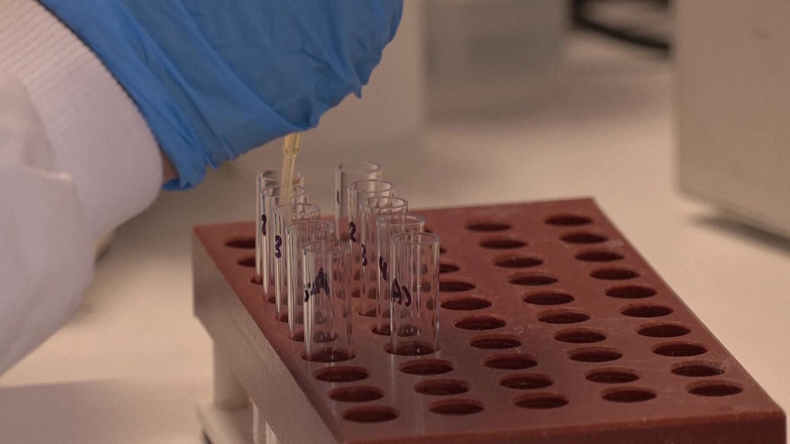 New blood test helps patients with sickle cell disease