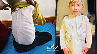 Gazze'de aşırı derecede yetersiz beslenen (açlık çeken) altı yaşındaki Fadi 