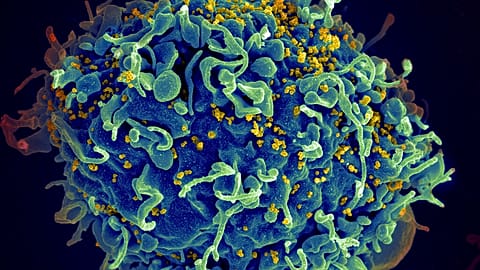 This electron microscope image made available by the U.S. National Institutes of Health shows a human T cell, in blue, under attack by HIV, in yellow, the virus that causes AI