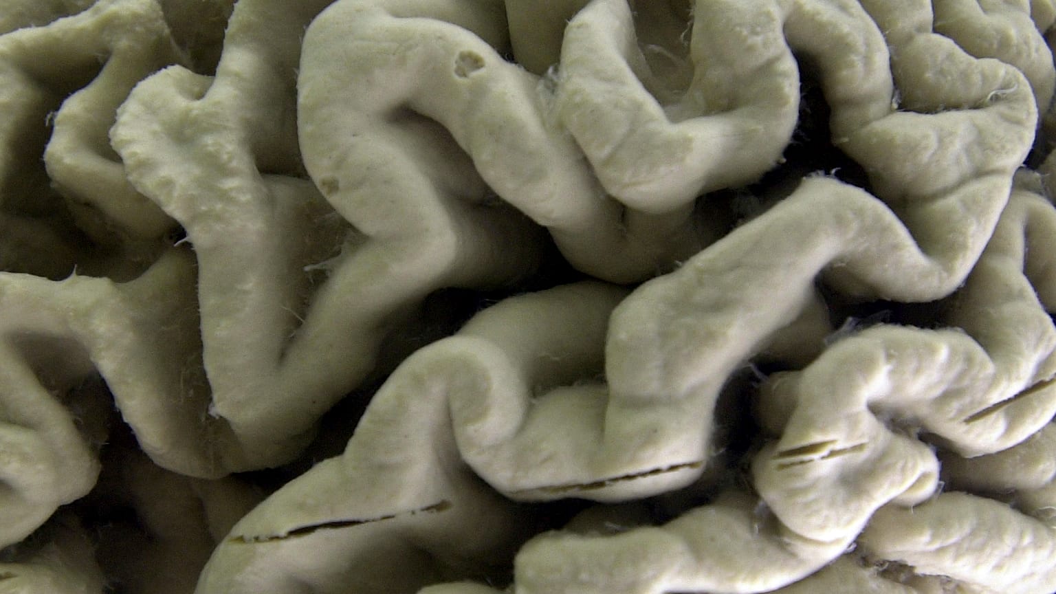 A section of a human brain with Alzheimer's disease is displayed at the Museum of Neuroanatomy at the University at Buffalo.