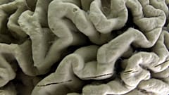 A section of a human brain with Alzheimer's disease is displayed at the Museum of Neuroanatomy at the University at Buffalo.