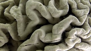 A section of a human brain with Alzheimer's disease is displayed at the Museum of Neuroanatomy at the University at Buffalo.