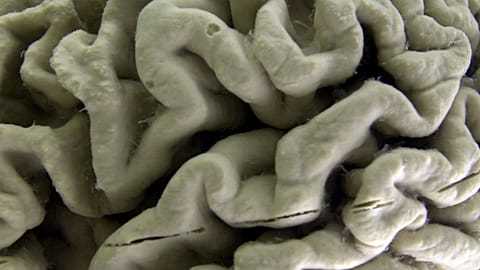 A section of a human brain with Alzheimer's disease is displayed at the Museum of Neuroanatomy at the University at Buffalo.