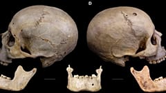 Der 4.000 Jahre alte Schädel trägt Spuren der möglicherweise frühesten Krebsbehandlung überhaupt.