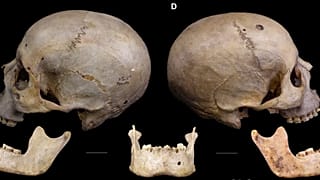 Der 4.000 Jahre alte Schädel trägt Spuren der möglicherweise frühesten Krebsbehandlung überhaupt.