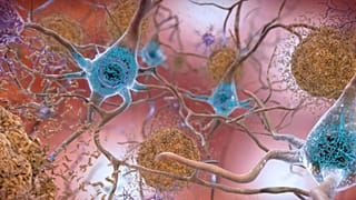 Sejtek egy Alzheimer-kórban szenvedő agyban