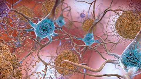 Sejtek egy Alzheimer-kórban szenvedő agyban