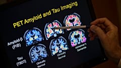  Archivo: Un médico señala los resultados de un escáner PET que forma parte de un estudio sobre la enfermedad de Alzhéimer en el Hospital Universitario de Georgetown.