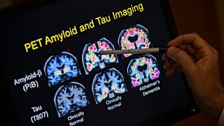 Un medico indica i risultati di una scansione PET che fa parte di uno studio sulla malattia di Alzheimer presso il Georgetown University Hospital.